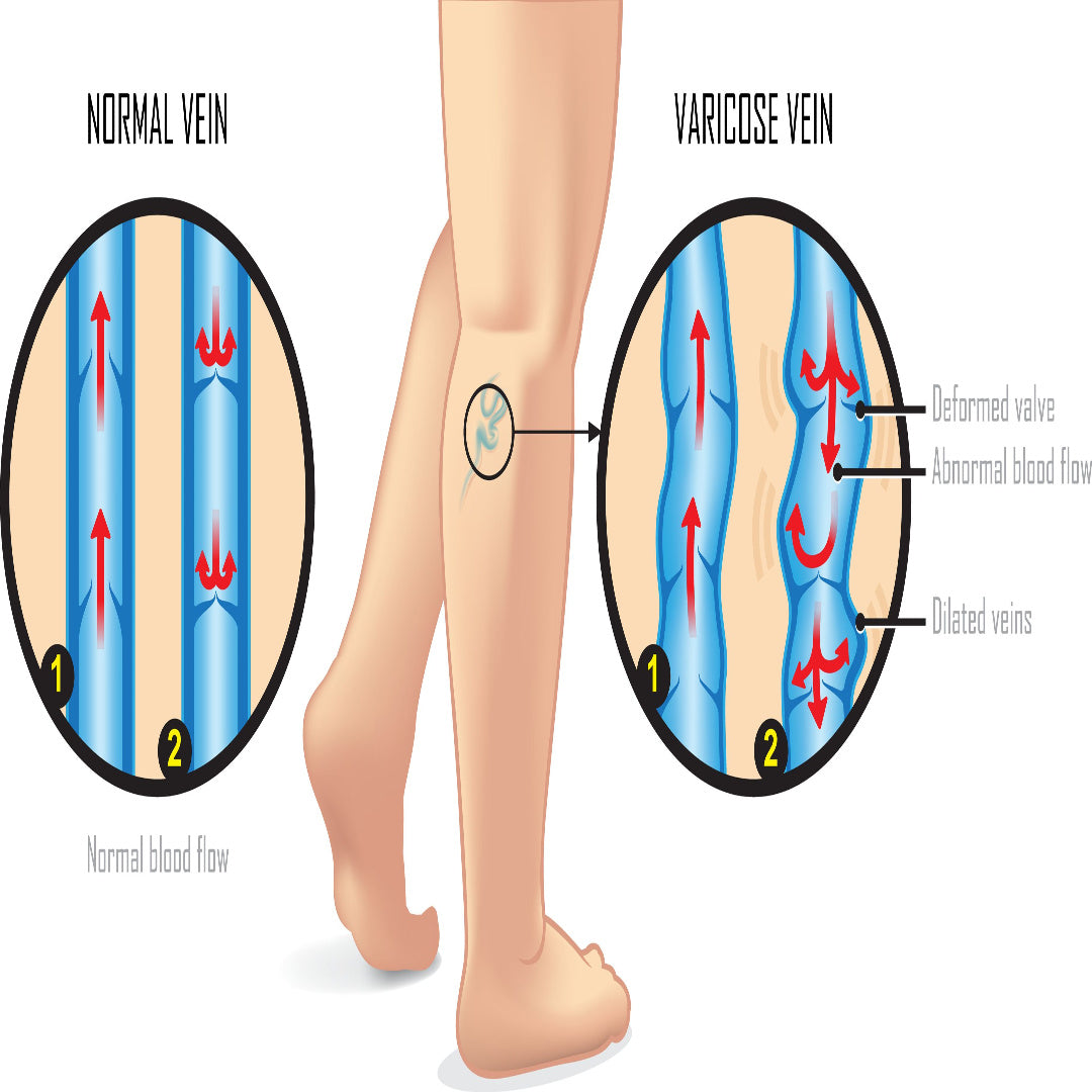 Unveiling the Truth about Varicose Veins: Understanding the Causes, Symptoms, and Treatment Options